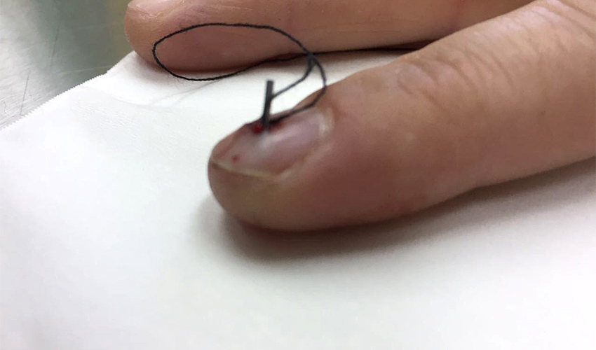 המחט שננעצה באצבעה של התופרת (צילום: דוברות שירותי בריאות כללית)