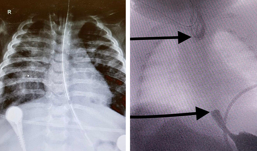 הוושט של הפעוטה לפני ואחרי הניתוח (צילום: דוברות הקריה הרפואית רמב"ם)