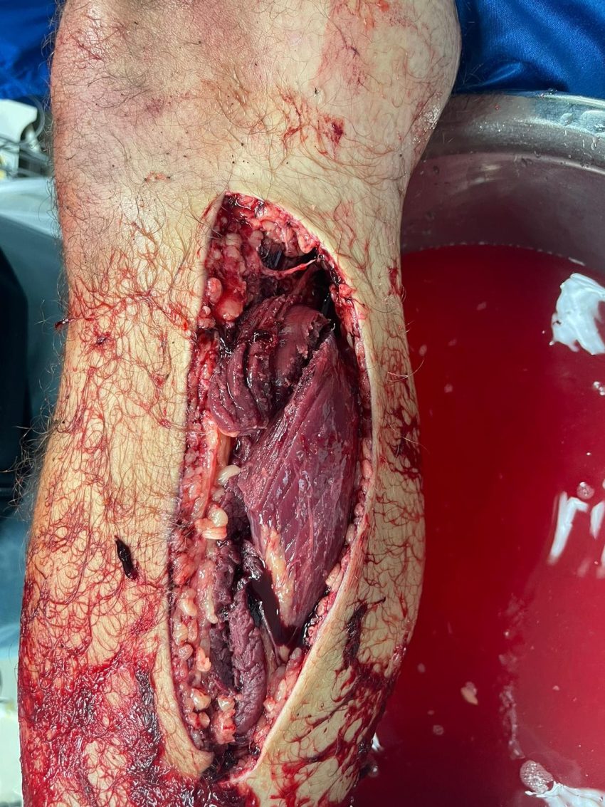 הפציעה של עידן שמולביץ' כפי שנראתה במרכז הרפואי כרמל (צילום: שימוש לפי סעיף 27 א' לחוק זכויות יוצרים)