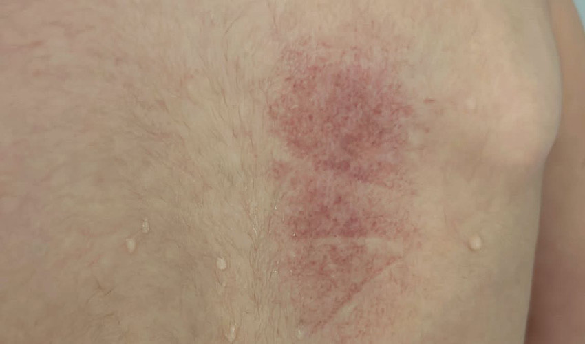 סימני אלימות על גבו של ילד מגן ריף