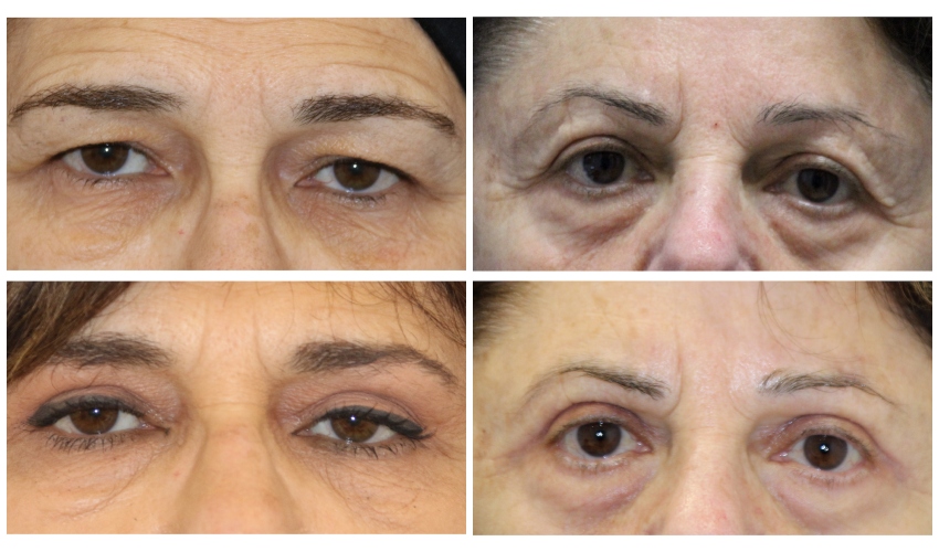 לפני ואחרי ניתוח עפעפיים עליונים (צילומים: באדיבות ד"ר צח שרוני)