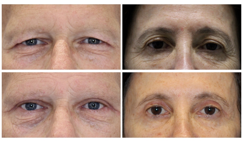 לפני ואחרי ניתוח עפעפיים עליונים (צילומים: באדיבות ד"ר צח שרוני)