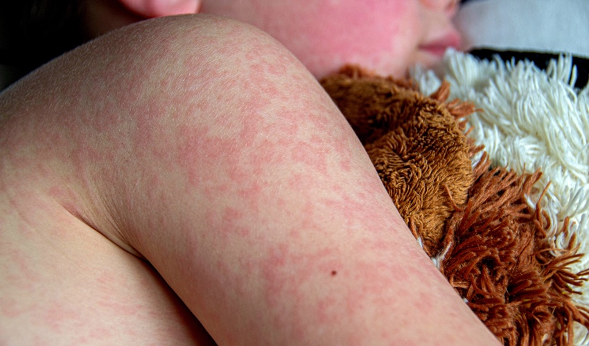 חצבת (צילום: milastokerpro/depositphotos.com)